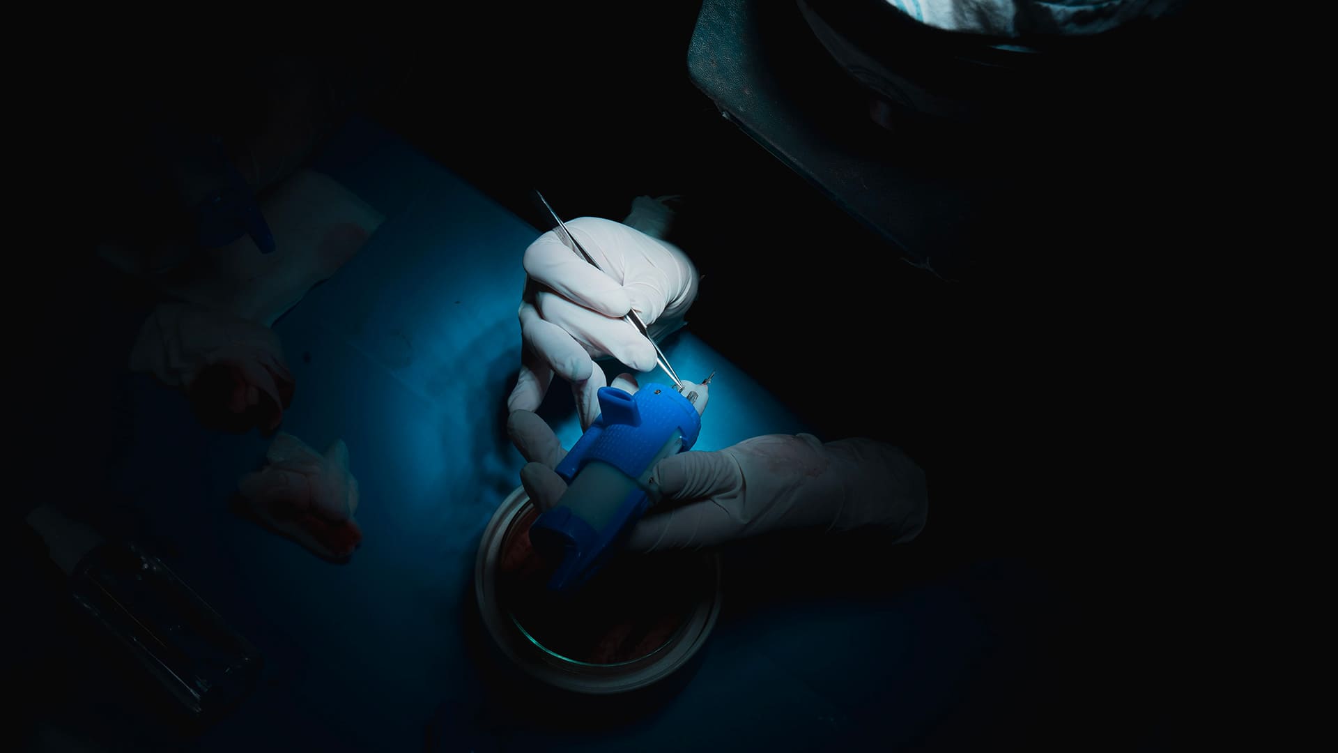 Autotrapianto di Capelli